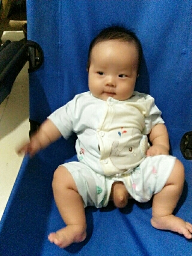 男宝宝蛋蛋大小不一样怎么回事
