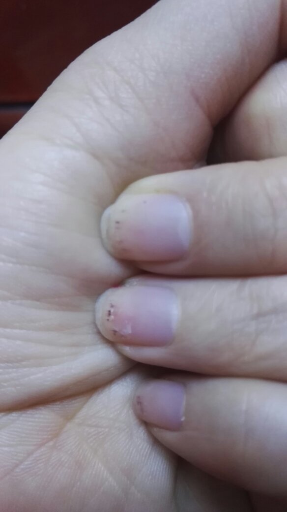 月经期间,指甲出现去如图黑点,貌似是淤血.请问这种现象严重吗?