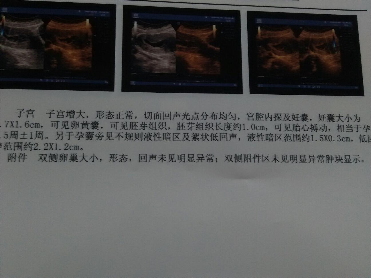 怀孕56天孕囊大小图片,怀孕56天真实胎儿图 怀孕56天有孕囊旁积液的进来讨论下!
