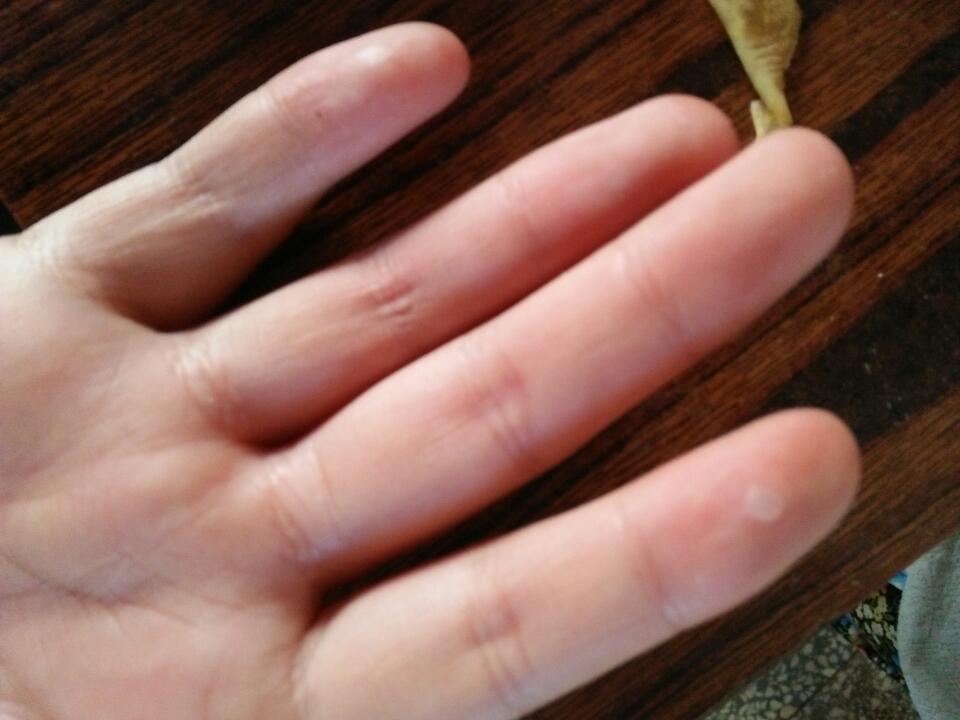 宝宝手上长了水泡是啥毛病