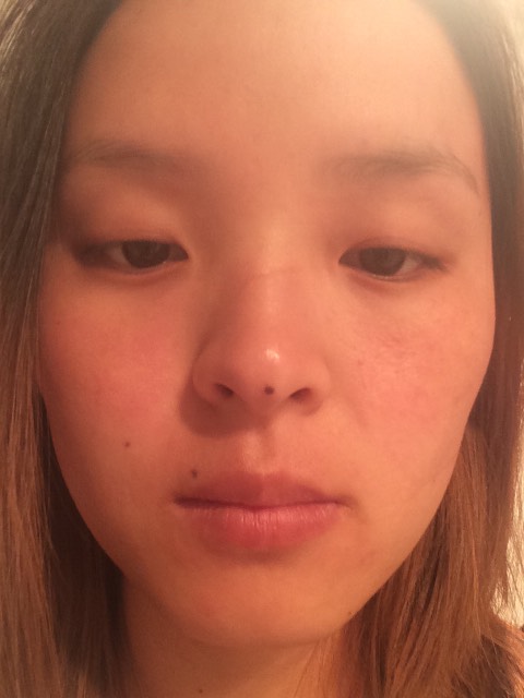 这些天脸上长了红红的一片一片摸上去好多小疙瘩,还很