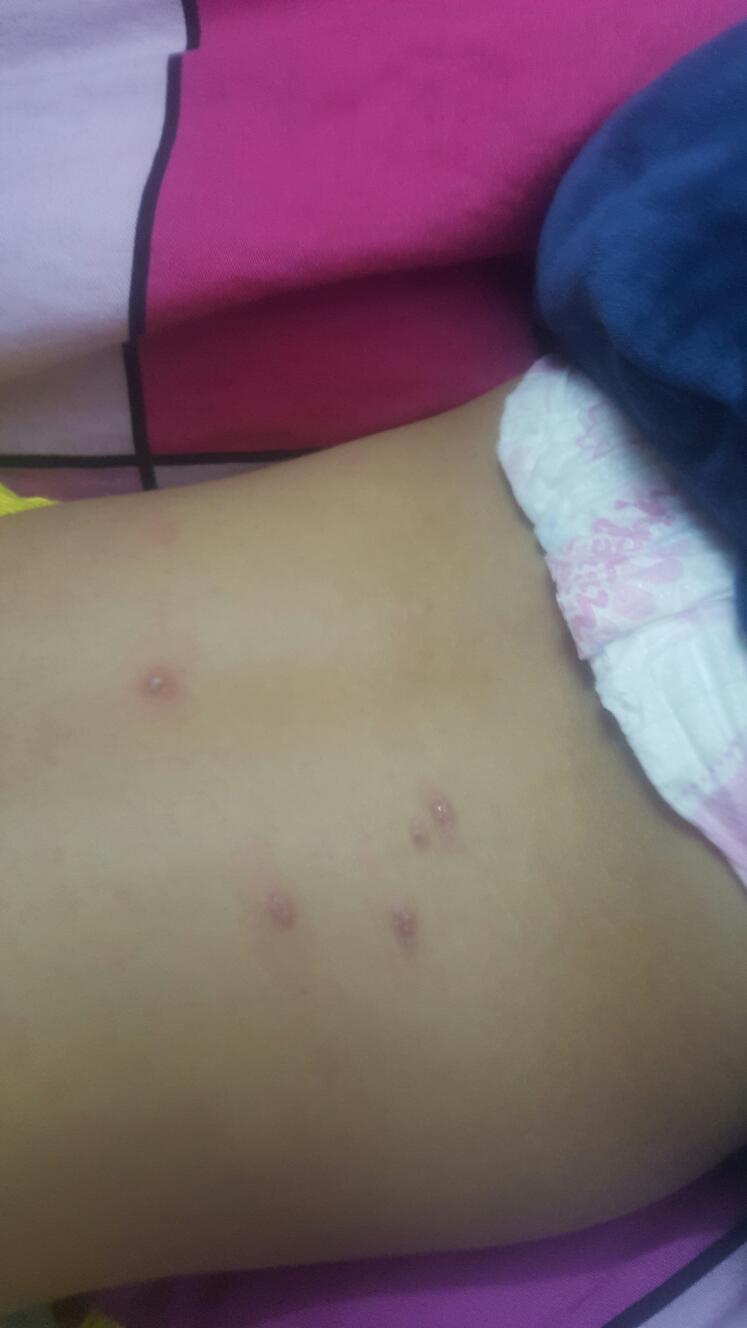 宝宝身上起疙瘩