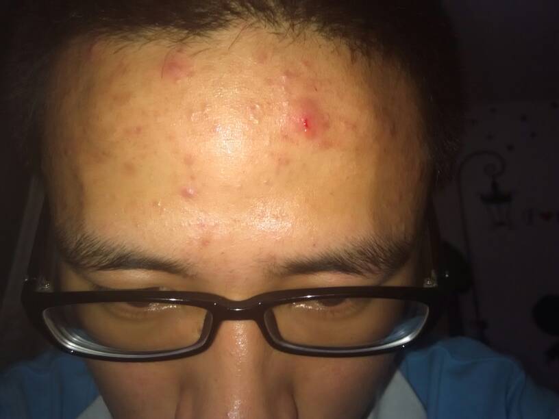额头老是起很多痘痘!基本都在额头!脸上也有不是很多!摸上去很疼!