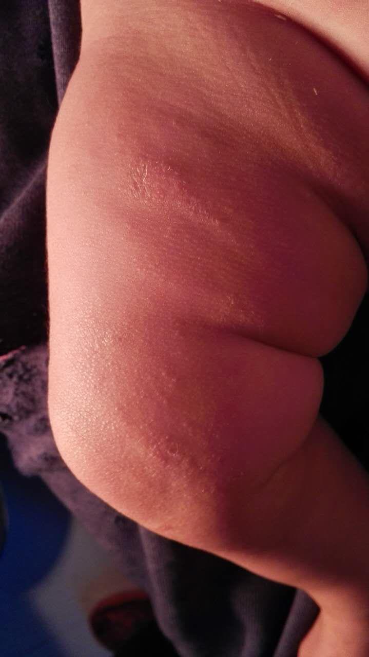 两个多月的宝宝,腿上怎么起的像癣一样的东西