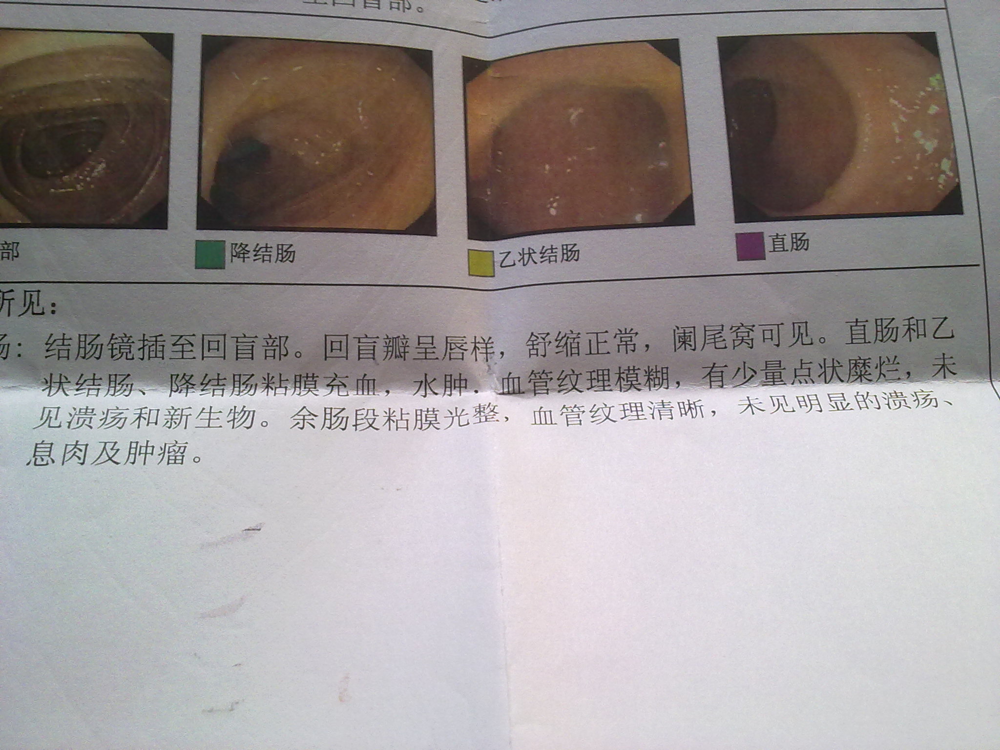 慢性结肠炎的症状及治疗