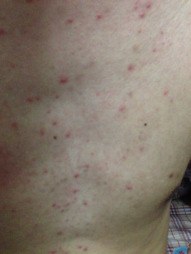 求助,胸前和后背长了好多痘痘,有什么办法很快去除的