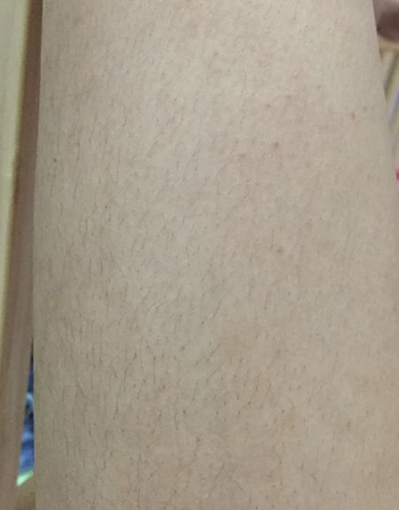脱完汗毛腿上留下类似鸡皮的红点点怎样去除?
