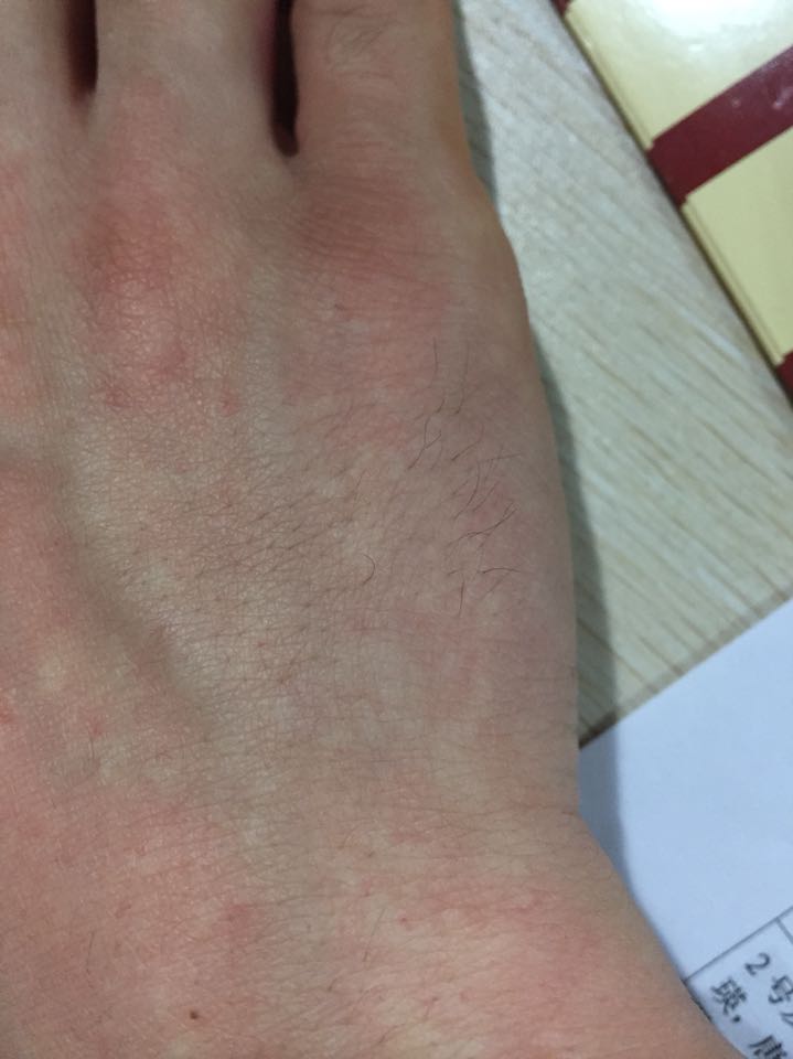 手背和手臂上有一点点的小白点,五六年了,问下是不是白斑病