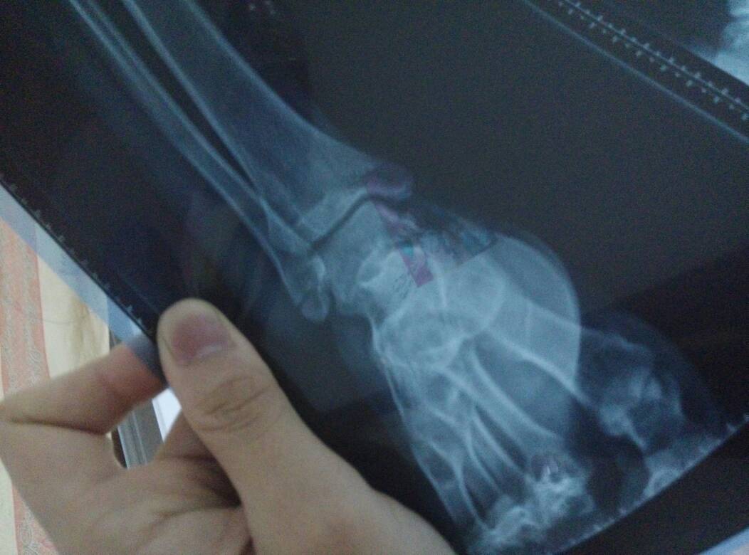 右脚踝外踝骨折,现已打石膏一个星期了,怎么脚底会发热但是手抚摸脚底