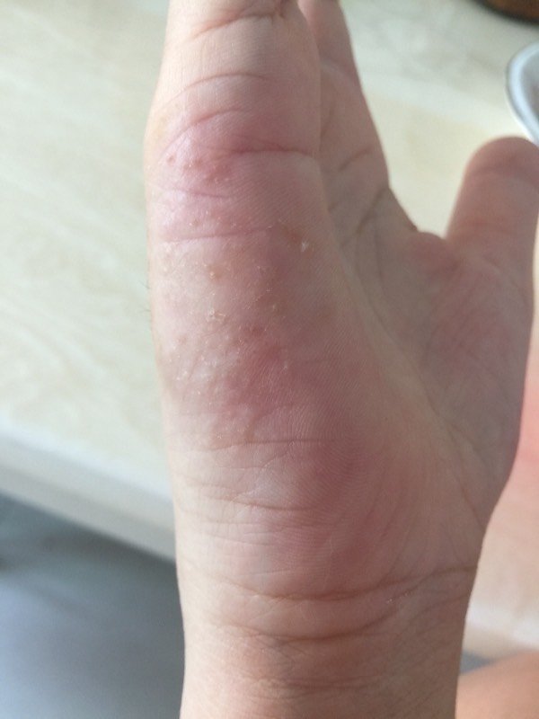 请问这是鹅掌风还是湿疹?