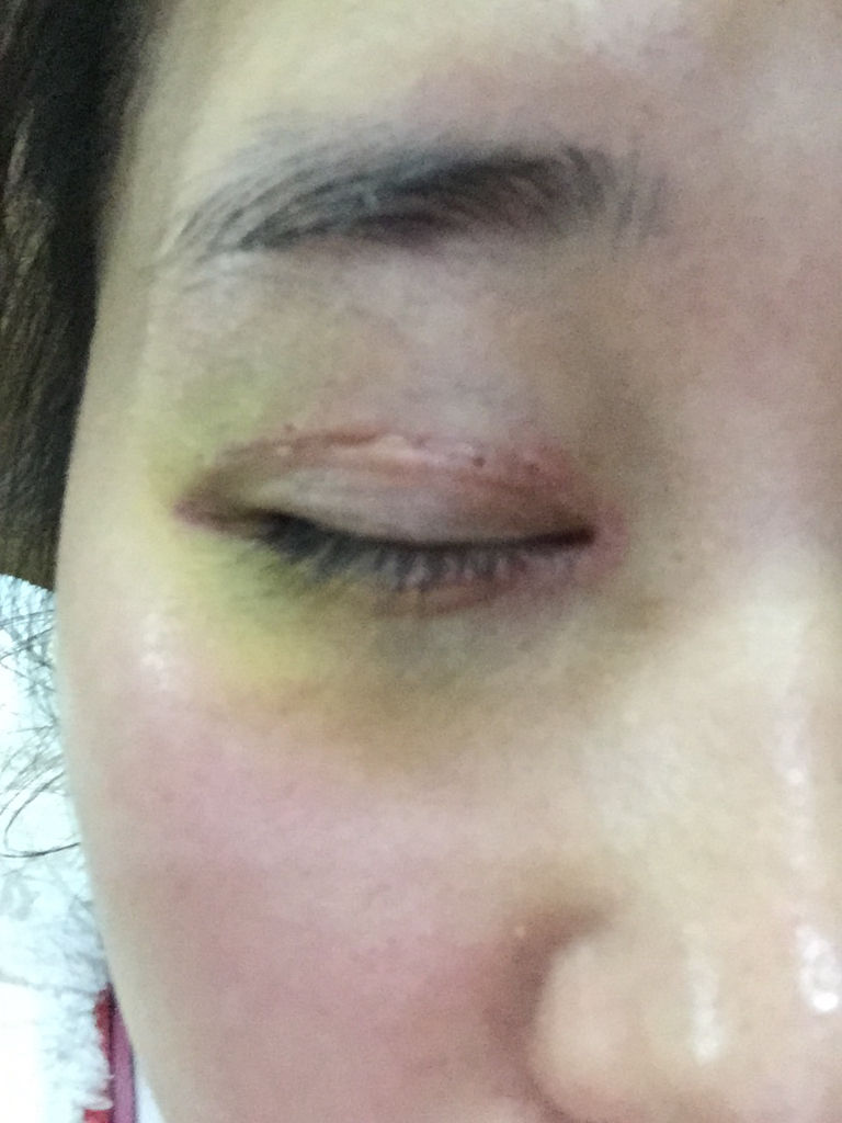 割双眼皮全切加开眼角第12天 第7天拆的线,发现眼皮上面有个小疙瘩问