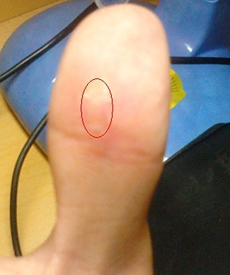 拇指这个地方写字时间长有硬块儿老是疼,不知道是茧子