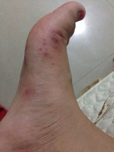 杨爱静 医师 我怀孕的时候脚破皮了 生完孩子脚上长好多小水泡 说是